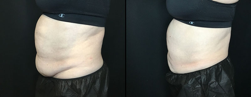 abdomen before after
