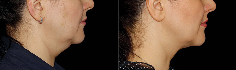 neck before after